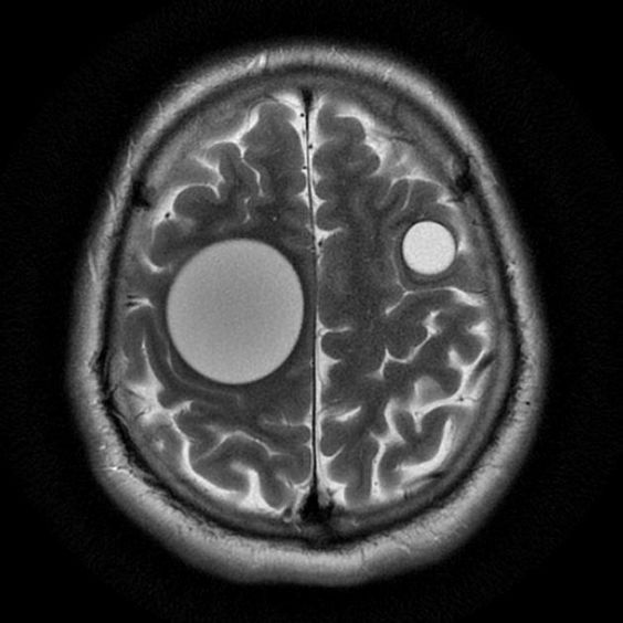 Киста, рак головного мозга